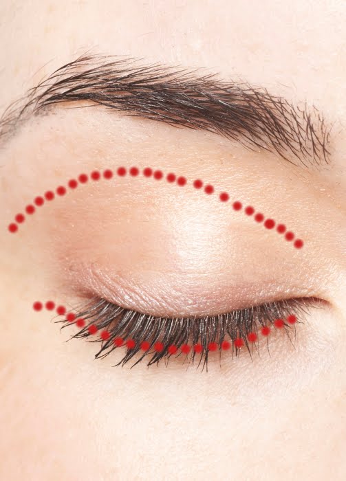 Incision site for Blepharoplasty Eyelid correction Surgery