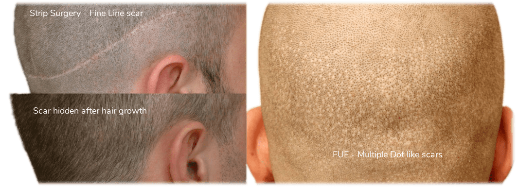 Best Hair Transplant in Jaipur