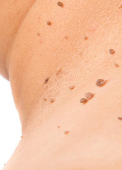 skin tags