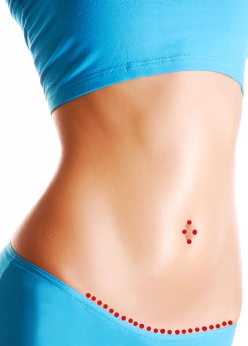 Achieve a Contoured and Youthful Midsection with a Belt Lipectomy