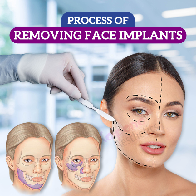 removing face implant