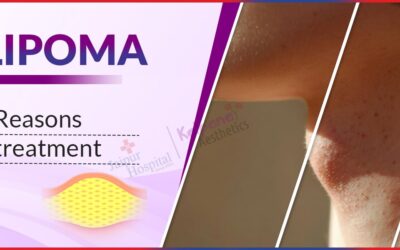 Lipoma: Reasons & treatment