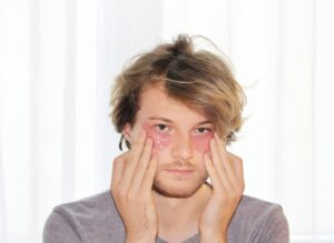 What are the symptoms of Blepharochalasis?