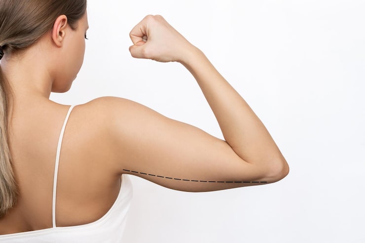 Arm Lift Surgery